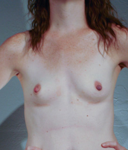 Breast Augmentation Before - Ft. Myers FL Breast Augmentation Before - Ft. Myers FL