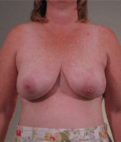 Breast Reconstruction After - Ft. Myers FL Breast Reconstruction After - Ft. Myers FL