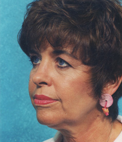 Facelift Before - Ft. Myers FL Facelift Before - Ft. Myers FL