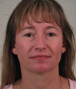 Nose Surgery (Rhinoplasty) Before - Ft. Myers FL Nose Surgery (Rhinoplasty) Before - Ft. Myers FL