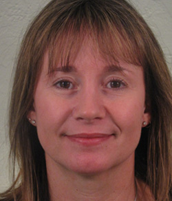 Nose Surgery (Rhinoplasty) After - Ft. Myers FL Nose Surgery (Rhinoplasty) After - Ft. Myers FL