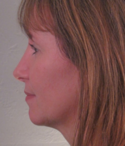 Nose Surgery (Rhinoplasty) After - Ft. Myers FL Nose Surgery (Rhinoplasty) After - Ft. Myers FL