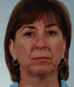 Nose Surgery (Rhinoplasty) Before - Ft. Myers FL Nose Surgery (Rhinoplasty) Before - Ft. Myers FL