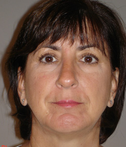 Nose Surgery (Rhinoplasty) After - Ft. Myers FL Nose Surgery (Rhinoplasty) After - Ft. Myers FL