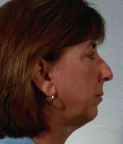 Nose Surgery (Rhinoplasty) Before - Ft. Myers FL Nose Surgery (Rhinoplasty) Before - Ft. Myers FL