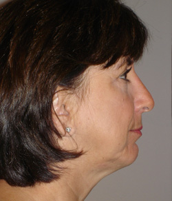Nose Surgery (Rhinoplasty) After - Ft. Myers FL Nose Surgery (Rhinoplasty) After - Ft. Myers FL