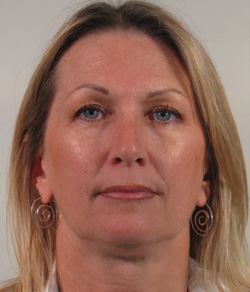 Nose Surgery (Rhinoplasty) Before - Ft. Myers FL