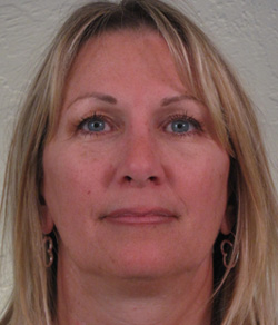 Nose Surgery (Rhinoplasty) After - Ft. Myers FL