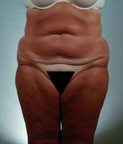 Tummy Tuck Before - Ft. Myers FL Tummy Tuck Before - Ft. Myers FL