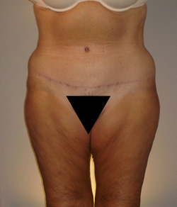 Tummy Tuck After - Ft. Myers FL Tummy Tuck After - Ft. Myers FL