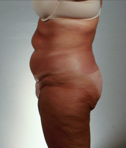 Tummy Tuck Before - Ft. Myers FL Tummy Tuck Before - Ft. Myers FL