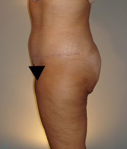 Tummy Tuck After - Ft. Myers FL Tummy Tuck After - Ft. Myers FL