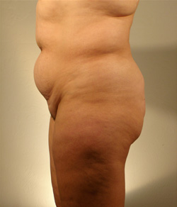 Tummy Tuck, Fort Myers, FL Click to View Tummy Tuck Gallery