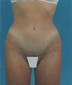 Tummy Tuck After - Ft. Myers FL