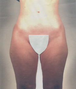 Tummy Tuck Before - Ft. Myers FL Tummy Tuck Before - Ft. Myers FL