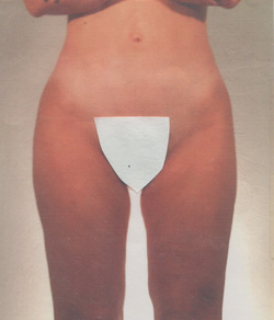 Tummy Tuck After - Ft. Myers FL Tummy Tuck After - Ft. Myers FL