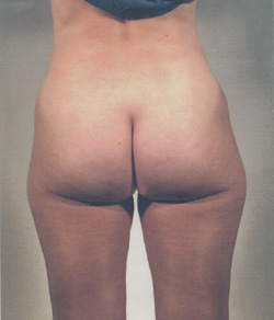 Tummy Tuck Before - Ft. Myers FL Tummy Tuck Before - Ft. Myers FL