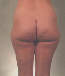 Tummy Tuck Before - Ft. Myers FL Tummy Tuck Before - Ft. Myers FL