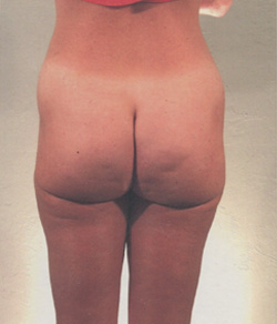 Tummy Tuck After - Ft. Myers FL Tummy Tuck After - Ft. Myers FL