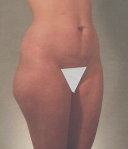 Tummy Tuck Before - Ft. Myers FL Tummy Tuck Before - Ft. Myers FL