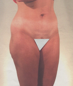 Tummy Tuck After - Ft. Myers FL Tummy Tuck After - Ft. Myers FL