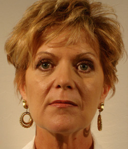 Eyelid Lift After - Ft. Myers FL Eyelid Lift After - Ft. Myers FL