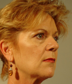 Eyelid Lift Before - Ft. Myers FL Eyelid Lift Before - Ft. Myers FL