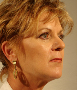 Eyelid Lift After - Ft. Myers FL Eyelid Lift After - Ft. Myers FL