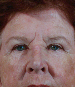 Eyelid Lift Before - Ft. Myers FL