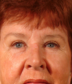 Eyelid Lift After - Ft. Myers FL 