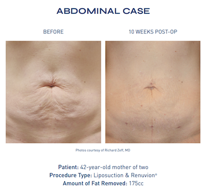 Before and after Renuvion® skin tightening