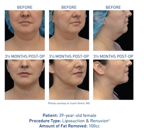 Before and after Renuvion® skin tightening