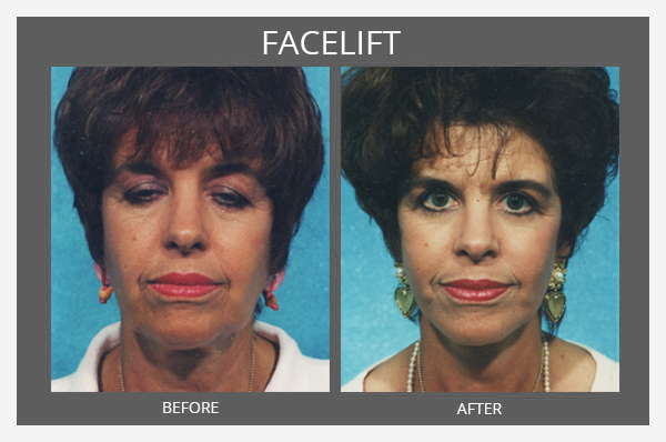 Facelift Before and After - Sharma Plastic Surgery