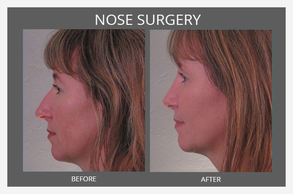 Nose Surgery Before and After - Sharma Plastic Surgery