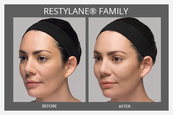 Restylane® Before and After - Sharma Plastic Surgery