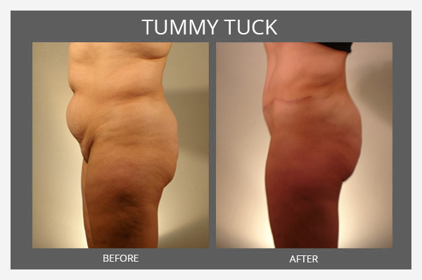 Tummy Tuck Before and After - Sharma Plastic Surgery