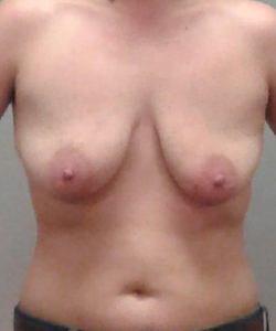 Breast Lift Before - Ft. Myers FL Breast Lift Before - Ft. Myers FL