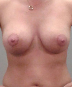 Breast Lift After - Ft. Myers FL Breast Lift After - Ft. Myers FL
