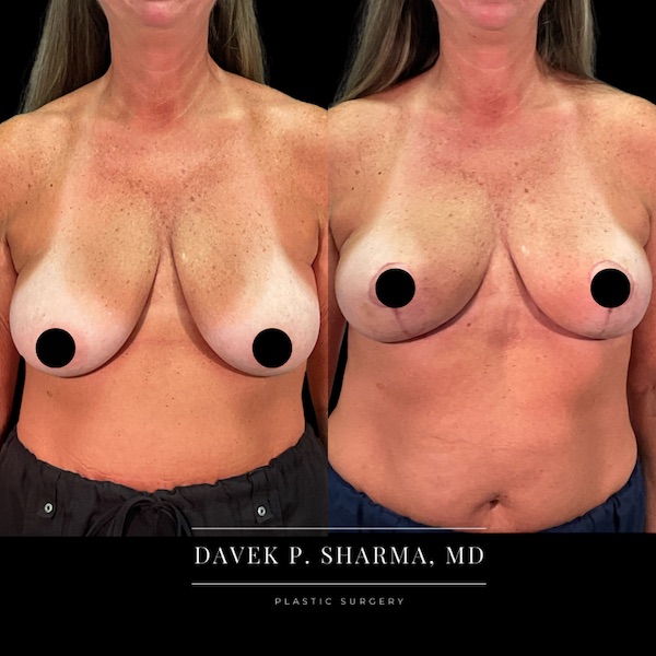 Breast Lift Before and After - Ft. Myers FL Breast Lift Before and After - Ft. Myers FL