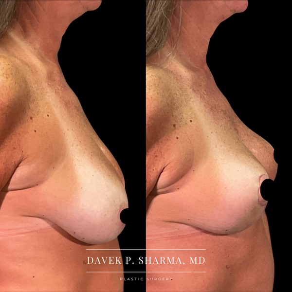 Breast Lift Before and After - Ft. Myers FL Breast Lift Before and After - Ft. Myers FL