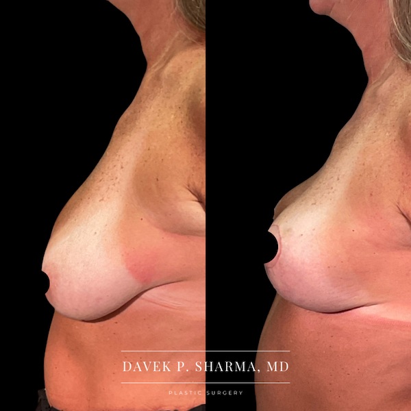 Breast Lift Before and After - Ft. Myers FL