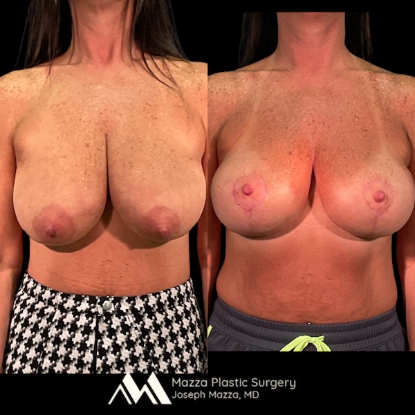 Breast Lift Before and After - Ft. Myers FL