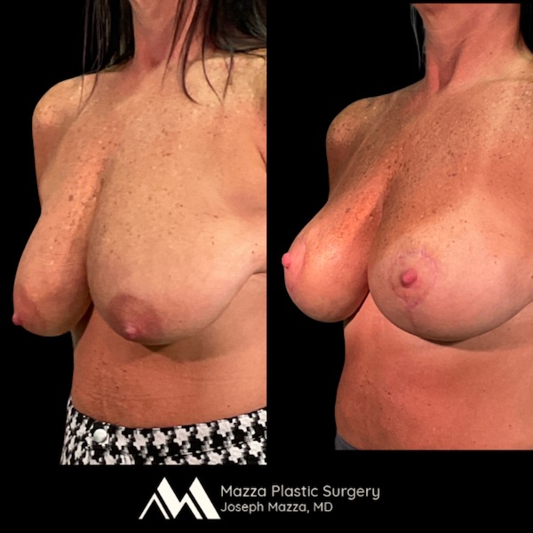 Breast Lift Before and After - Ft. Myers FL