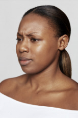 Dysport® Before - Ft. Myers FL