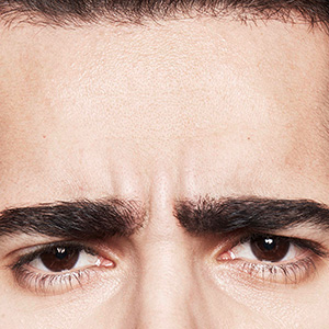 Dysport® Before - Ft. Myers FL Dysport® Before - Ft. Myers FL