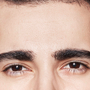 Dysport® After - Ft. Myers FL Dysport® After - Ft. Myers FL