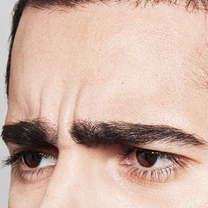 Dysport® Before - Ft. Myers FL Dysport® Before - Ft. Myers FL