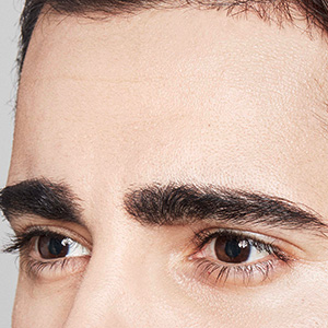 Dysport® After - Ft. Myers FL Dysport® After - Ft. Myers FL