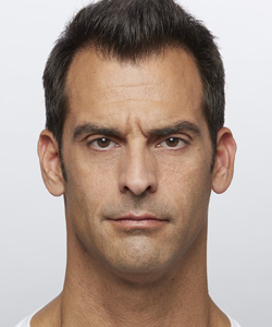 Dysport® Before - Ft. Myers FL Dysport® Before - Ft. Myers FL