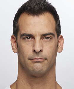 Dysport® After - Ft. Myers FL Dysport® After - Ft. Myers FL